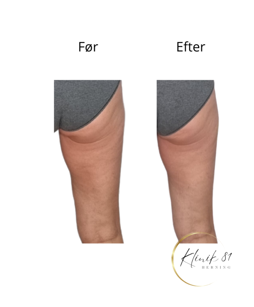 Opstramning lår, fedtsugning lår, fedtsugning knæ, fedtreduktion lår, reduktion af cellulite, reduktion af appelsinhud,, fedtfrysning lår, fedtfrysning knæ, fedtreduktion knæ, Klinik 81, 