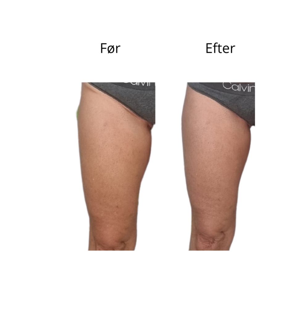 Opstramning lår, fedtsugning lår, fedtsugning knæ, fedtreduktion lår, reduktion af cellulite, reduktion af appelsinhud,, fedtfrysning lår, fedtfrysning knæ, fedtreduktion knæ, Klinik 81,