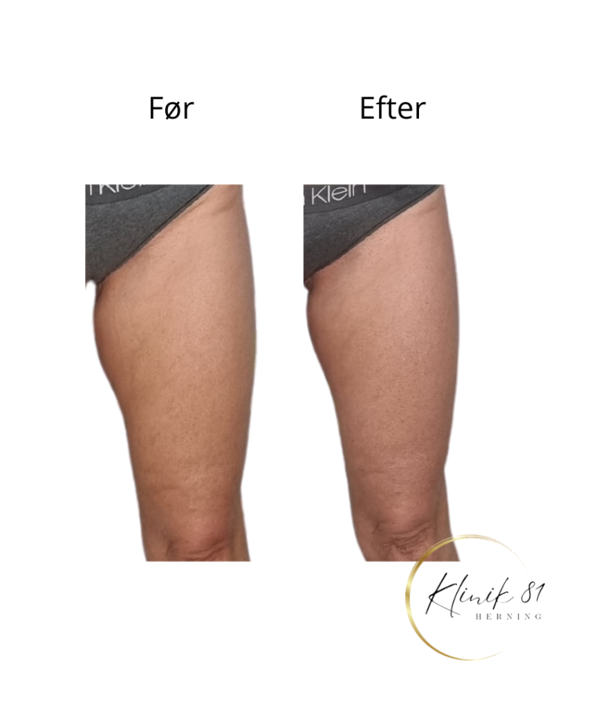 Opstramning lår, fedtsugning lår, fedtsugning knæ, fedtreduktion lår, reduktion af cellulite, reduktion af appelsinhud,, fedtfrysning lår, fedtfrysning knæ, fedtreduktion knæ, Klinik 81, 