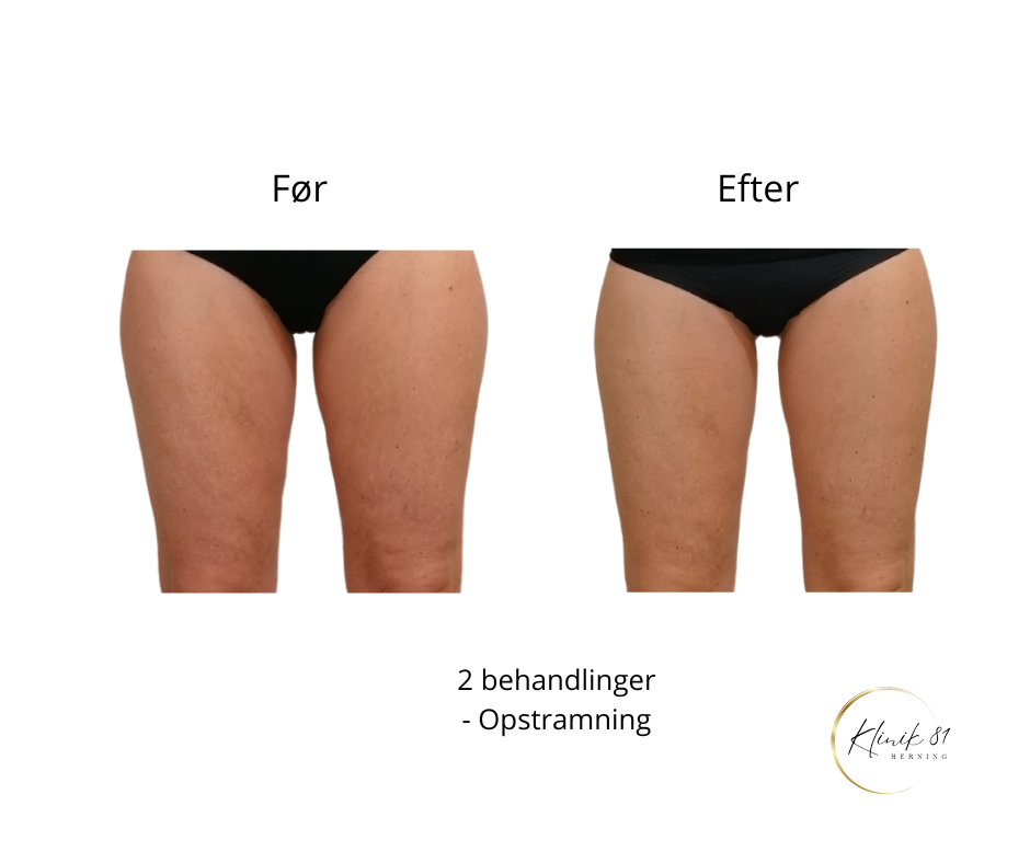 Opstramning lår, fedtsugning lår, fedtsugning knæ, fedtreduktion lår, reduktion af cellulite, reduktion af appelsinhud,, fedtfrysning lår, fedtfrysning knæ, fedtreduktion knæ,  Klinik 81, 