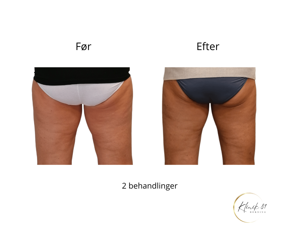 Opstramning lår, fedtsugning lår, fedtsugning knæ, fedtreduktion lår, reduktion af cellulite, reduktion af appelsinhud,, fedtfrysning lår, fedtfrysning knæ, fedtreduktion knæ,