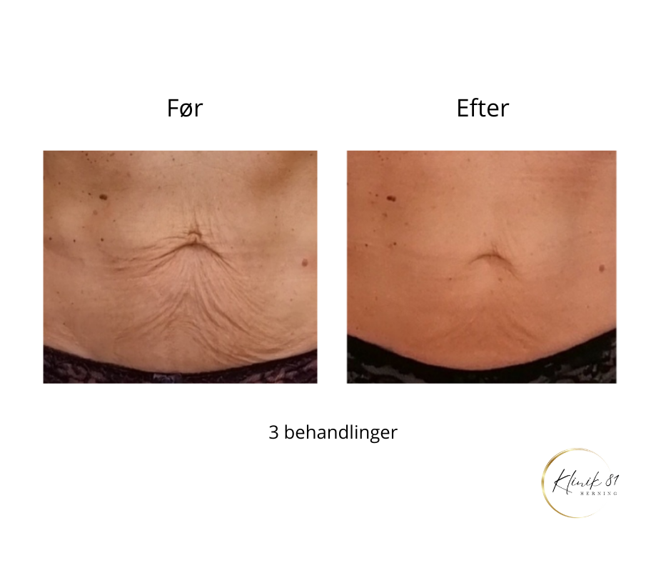 Onda Coolwaves
Fedtreduktion
Hudopstramning
Reduktion af cellulite
Prisvindende behandlinger med dokumenteret effekt - uden kirurgi.
Klinik 81