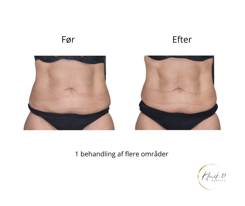 Onda Coolwaves
Fedtreduktion
Hudopstramning
Reduktion af cellulite
Prisvindende behandlinger med dokumenteret effekt - uden kirurgi.
Klinik 81