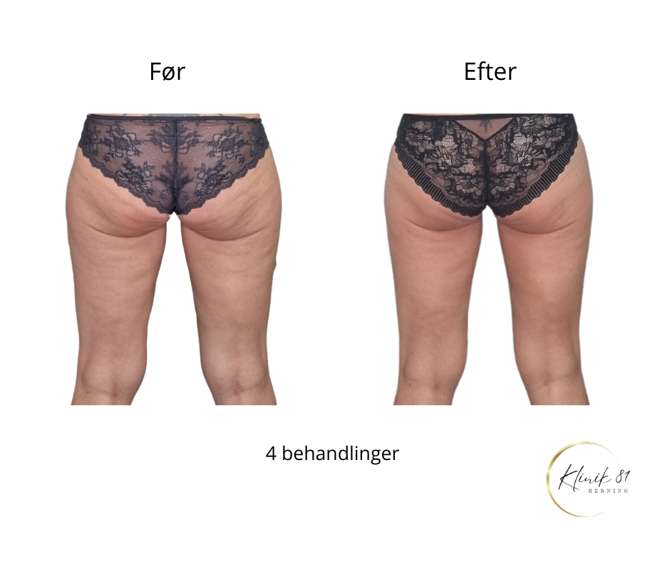 Opstramning lår, fedtsugning lår, fedtsugning knæ, fedtreduktion lår, reduktion af cellulite, reduktion af appelsinhud,, fedtfrysning lår, fedtfrysning knæ, fedtreduktion knæ, Klinik 81, 