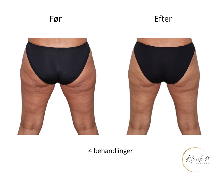 Opstramning lår, fedtsugning lår, fedtsugning knæ, fedtreduktion lår, reduktion af cellulite, reduktion af appelsinhud,, fedtfrysning lår, fedtfrysning knæ, fedtreduktion knæ, Klinik 81, 