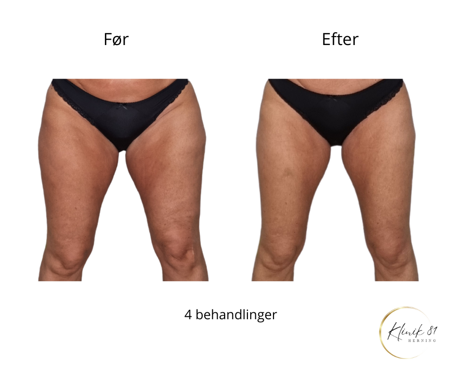 Opstramning lår, fedtsugning lår, fedtsugning knæ, fedtreduktion lår, reduktion af cellulite, reduktion af appelsinhud,, fedtfrysning lår, fedtfrysning knæ, fedtreduktion knæ, Klinik 81, 