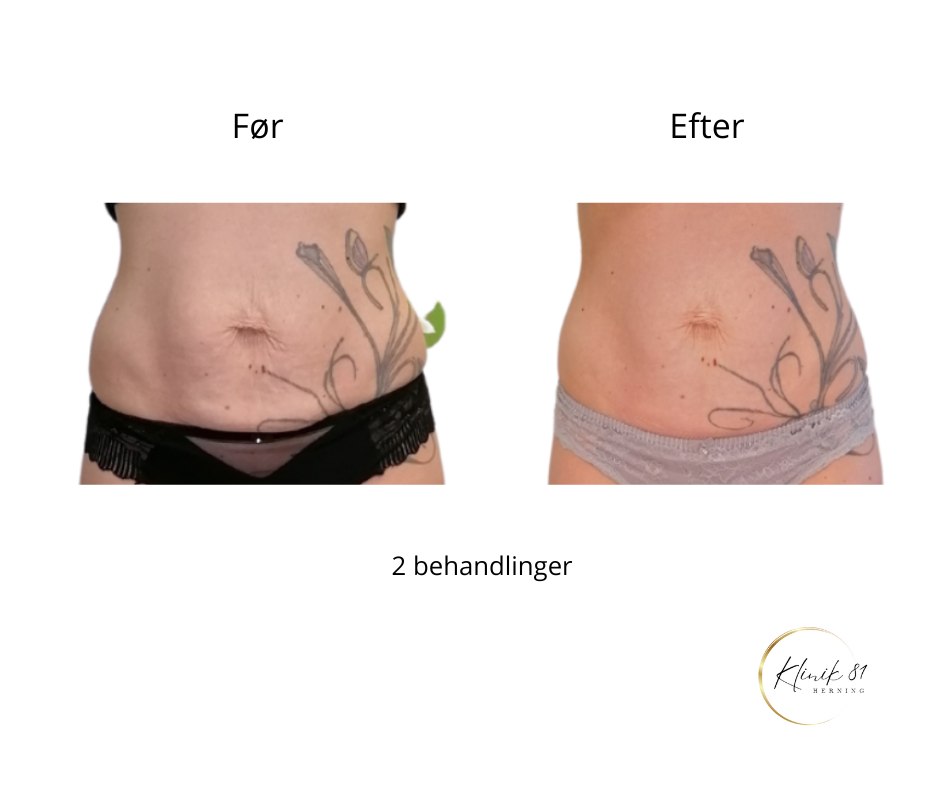 Onda Coolwaves
Fedtreduktion
Hudopstramning
Reduktion af cellulite
Prisvindende behandlinger med dokumenteret effekt - uden kirurgi.
Klinik 81