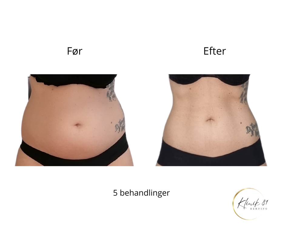 Onda Coolwaves
Fedtreduktion
Hudopstramning
Reduktion af cellulite
Prisvindende behandlinger med dokumenteret effekt - uden kirurgi.
Klinik 81