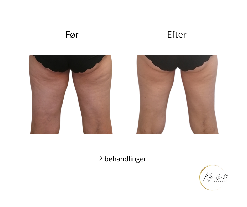 Opstramning lår, fedtsugning lår, fedtsugning knæ, fedtreduktion lår, reduktion af cellulite, reduktion af appelsinhud,, fedtfrysning lår, fedtfrysning knæ, fedtreduktion knæ,