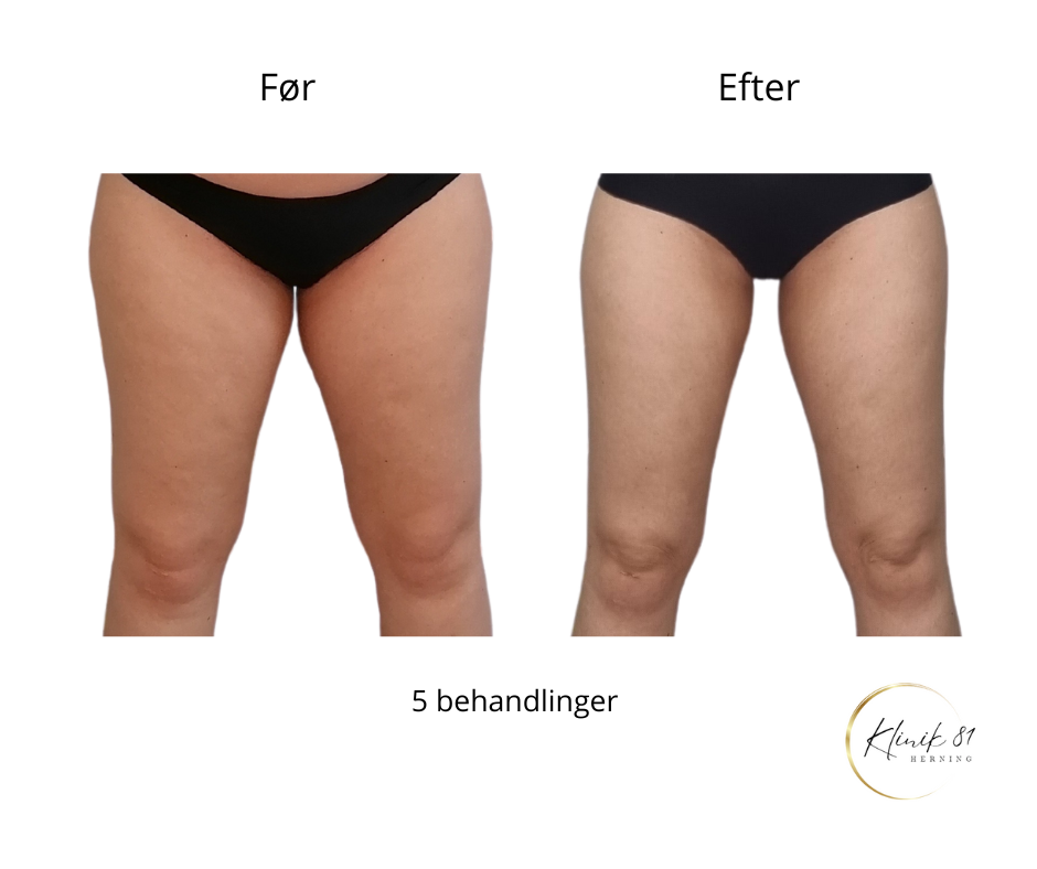 Opstramning lår, fedtsugning lår, fedtsugning knæ, fedtreduktion lår, reduktion af cellulite, reduktion af appelsinhud,, fedtfrysning lår, fedtfrysning knæ, fedtreduktion knæ, Klinik 81, 