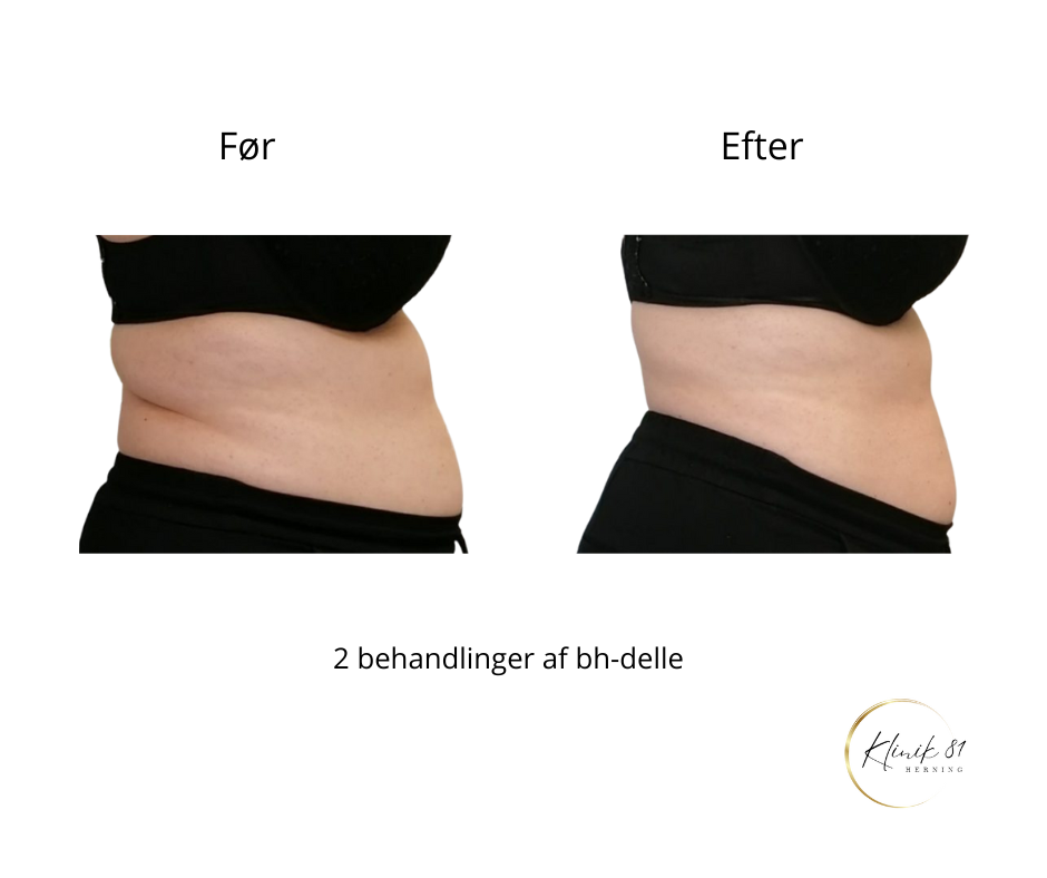 Onda Coolwaves
Fedtreduktion
Hudopstramning
Reduktion af cellulite
Prisvindende behandlinger med dokumenteret effekt - uden kirurgi.
Klinik 81