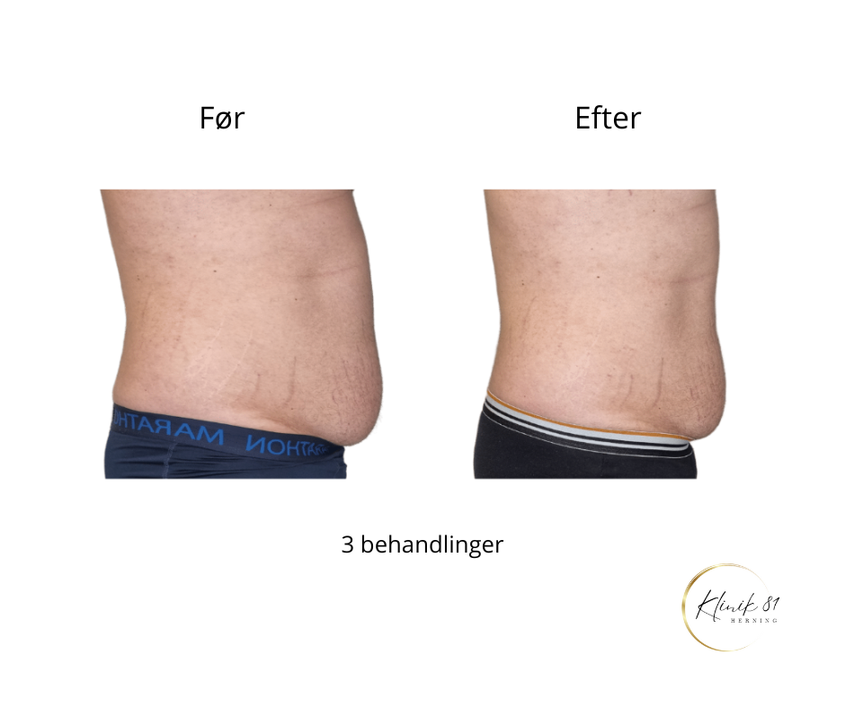 Fedtreduktion mave, fedtsugning mave, Onda Coolwaves, fedtfrysning mave, Onda Coolwaves
Fedtreduktion
Hudopstramning
Reduktion af cellulite
Prisvindende behandlinger med dokumenteret effekt - uden kirurgi.
Klinik 81