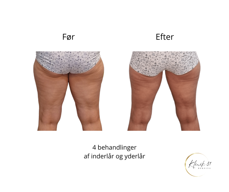 Opstramning lår, fedtsugning lår, fedtsugning knæ, fedtreduktion lår, reduktion af cellulite, reduktion af appelsinhud,, fedtfrysning lår, fedtfrysning knæ, fedtreduktion knæ, Klinik 81, 