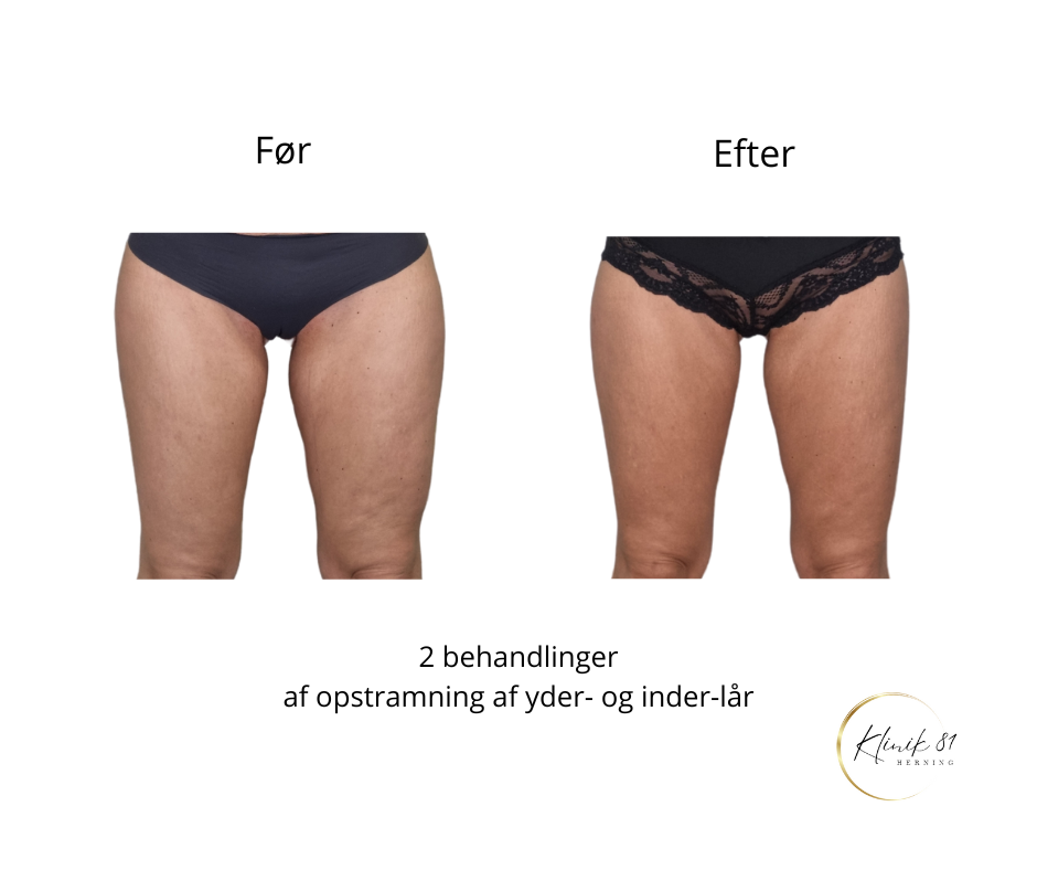 Opstramning lår, fedtsugning lår, fedtsugning knæ, fedtreduktion lår, reduktion af cellulite, reduktion af appelsinhud,, fedtfrysning lår, fedtfrysning knæ, fedtreduktion knæ, Klinik 81, 