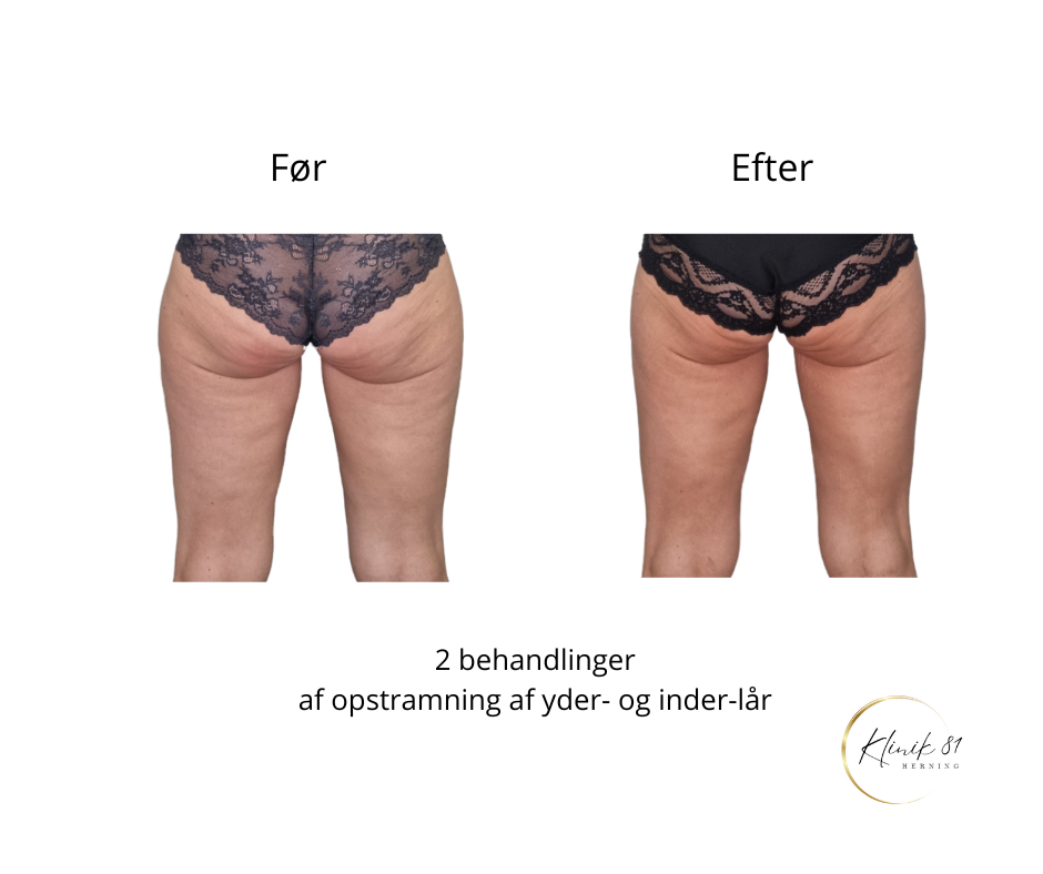 Opstramning lår, fedtsugning lår, fedtsugning knæ, fedtreduktion lår, reduktion af cellulite, reduktion af appelsinhud,, fedtfrysning lår, fedtfrysning knæ, fedtreduktion knæ, Klinik 81, 