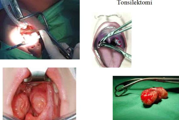 Tonsilektomi
