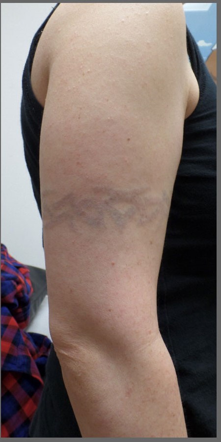 Tatueringsborttagning i göteborg laserklinikcenter före och efter före och efter