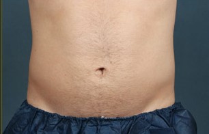 coolsculpting-before-after-3.jpg