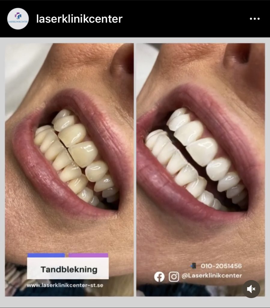 Vita tänder, tandblekning