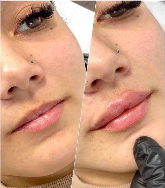 606505732aa9851f143e4e2e_First time lip filler-p-1080