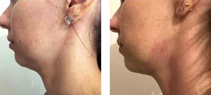 Before after RF Skin Tightening