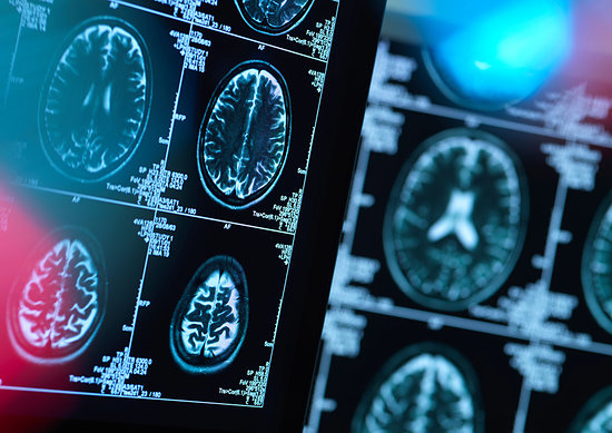 Brain scans of possible disease