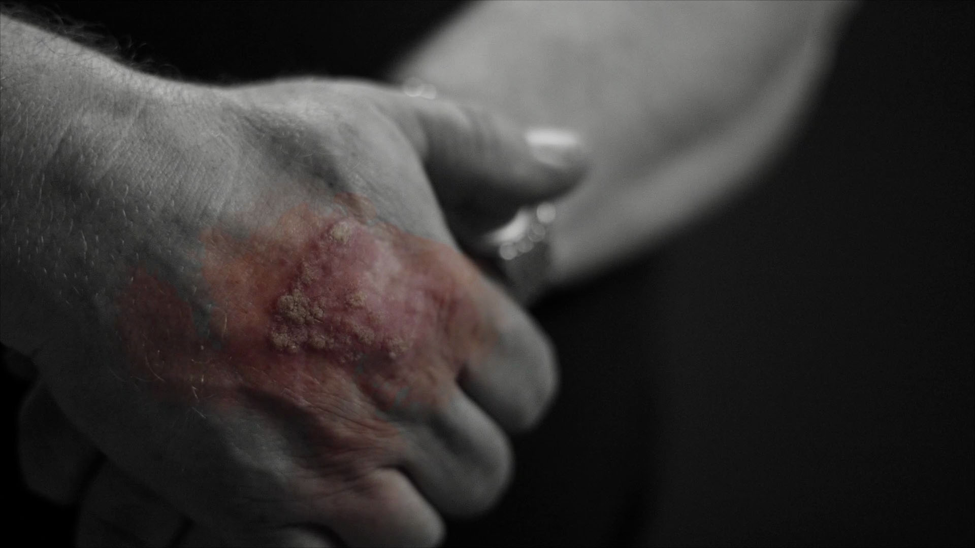 Psoriasisforening screengrab 10