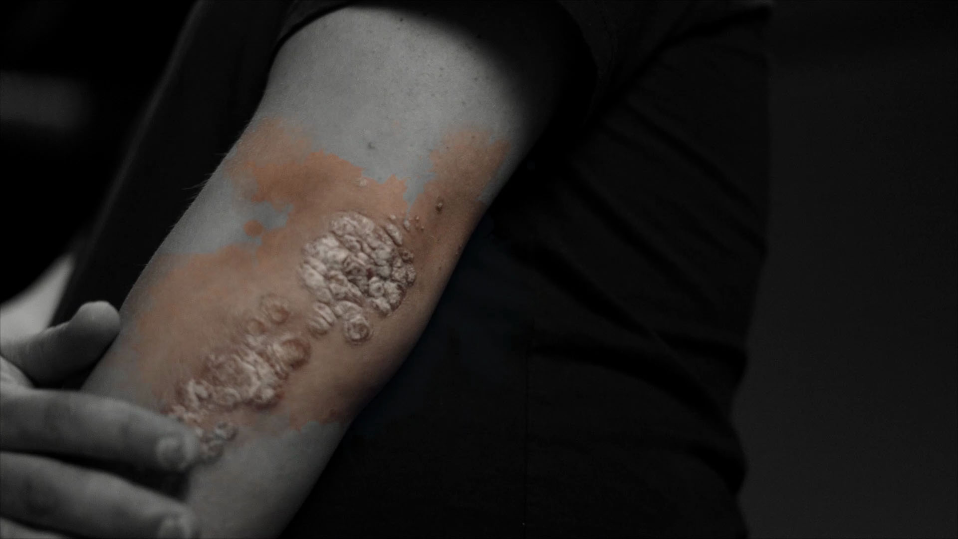 Psoriasisforening screengrab 7