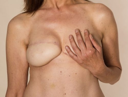 Bröstcancer kvinnohälsa