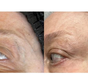 Those experiencing sun damage, rosacea, irregular pigmentation, or visible blood vessels and are looking for a non-invasive solution can greatly benefit from Laser IPL Therapy