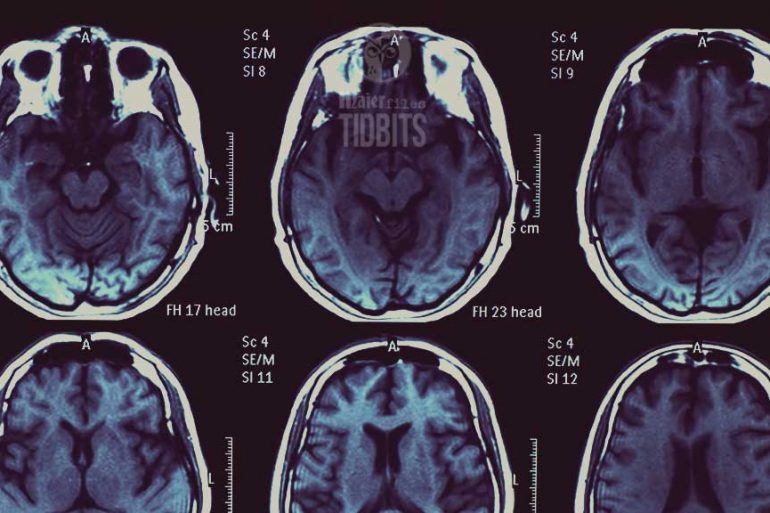 brain scans