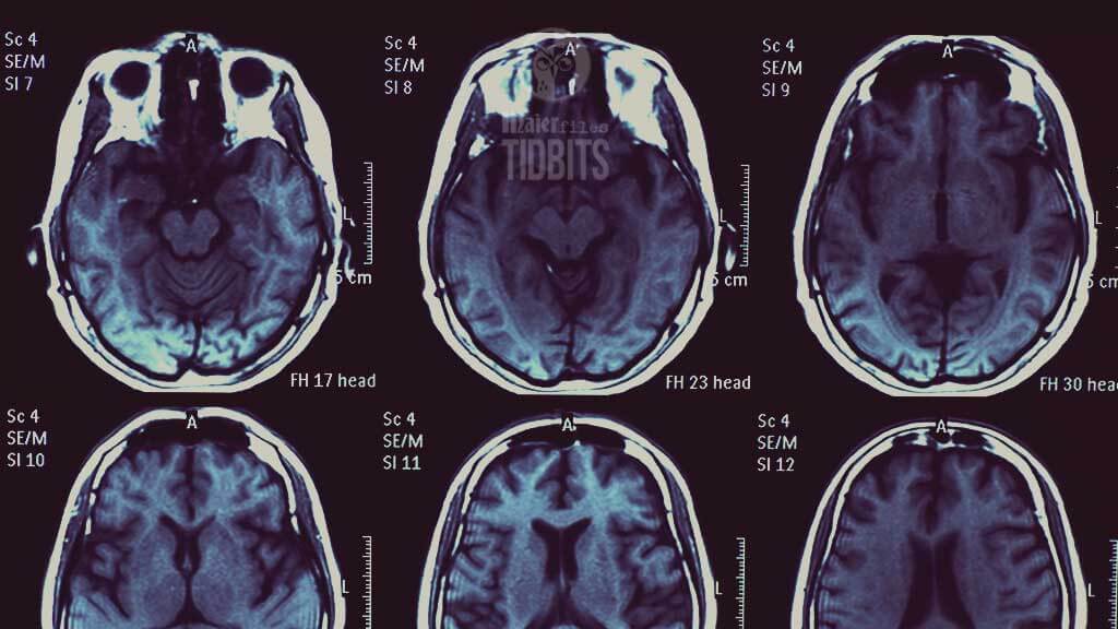 brain scans