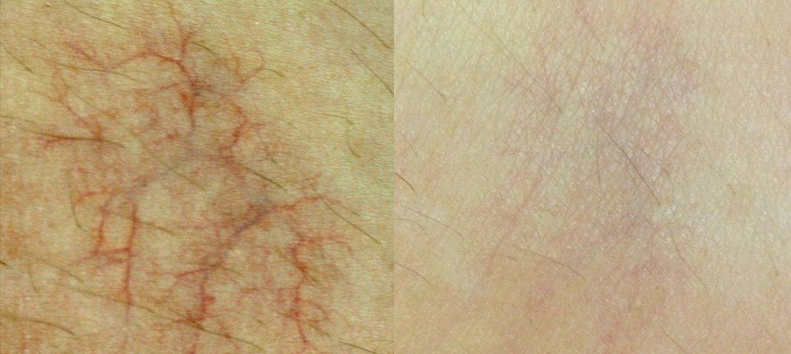 vascular Courtesy of B.L. Goo, MD