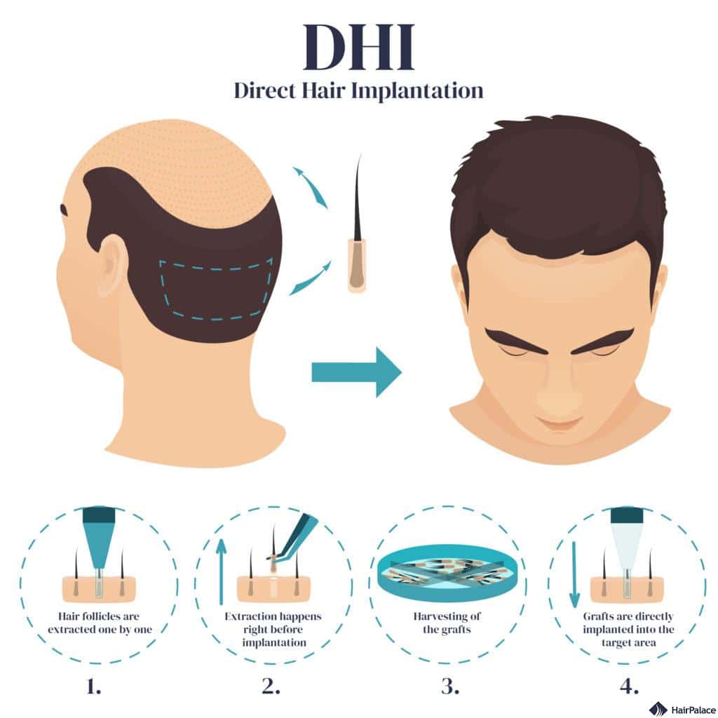 dhi direct hair implantation