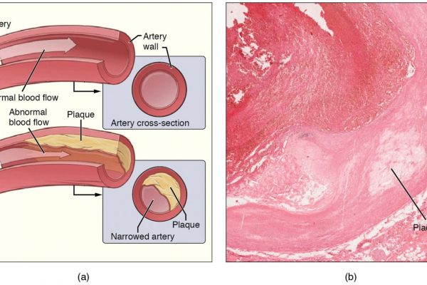 Scientists find cancer-like features in atherosclerosis, spurring opportunity for new treatment approaches