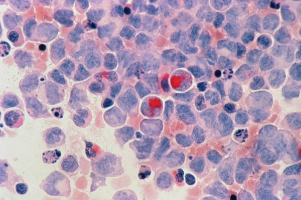 Researchers discover new target for potential leukemia therapy