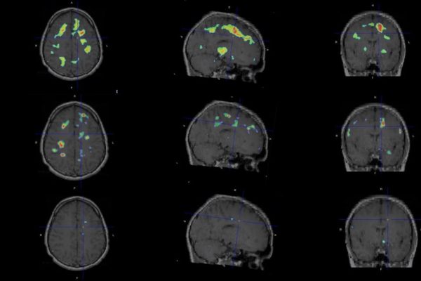 PET reveals ‘smoldering’ brain inflammation in patients treated for MS PET reveals ‘smoldering’ brain inflammation in patients treated for MS