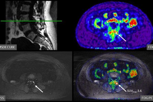 ISMRM: PET/MRI shows promise identifying musculoskeletal ‘pain generators’ ISMRM: PET/MRI shows promise identifying musculoskeletal ‘pain generators’