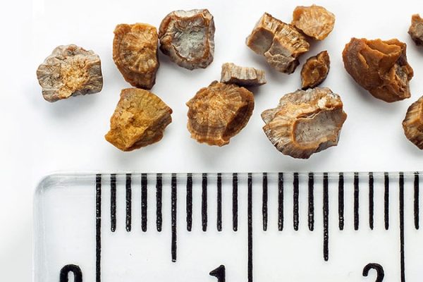 Office Procedure Found to Get Stone Fragments Rolling Office Procedure Found to Get Stone Fragments Rolling