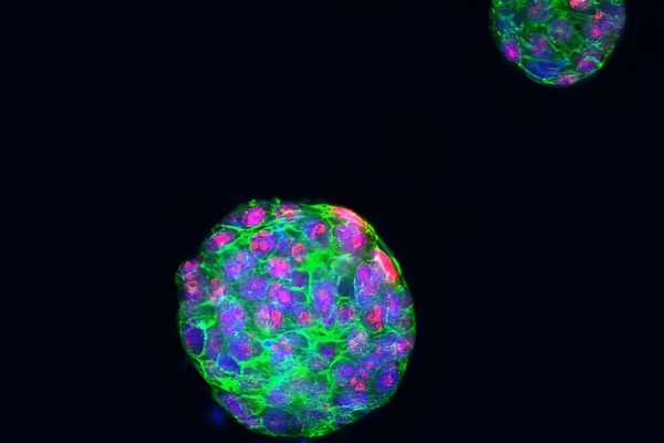 Researchers identify what drives PARP inhibitor resistance in advanced breast cancer