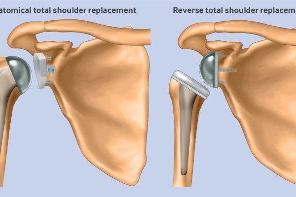 Study sheds light on the debate around two types of shoulder replacement surgery for osteoarthritis