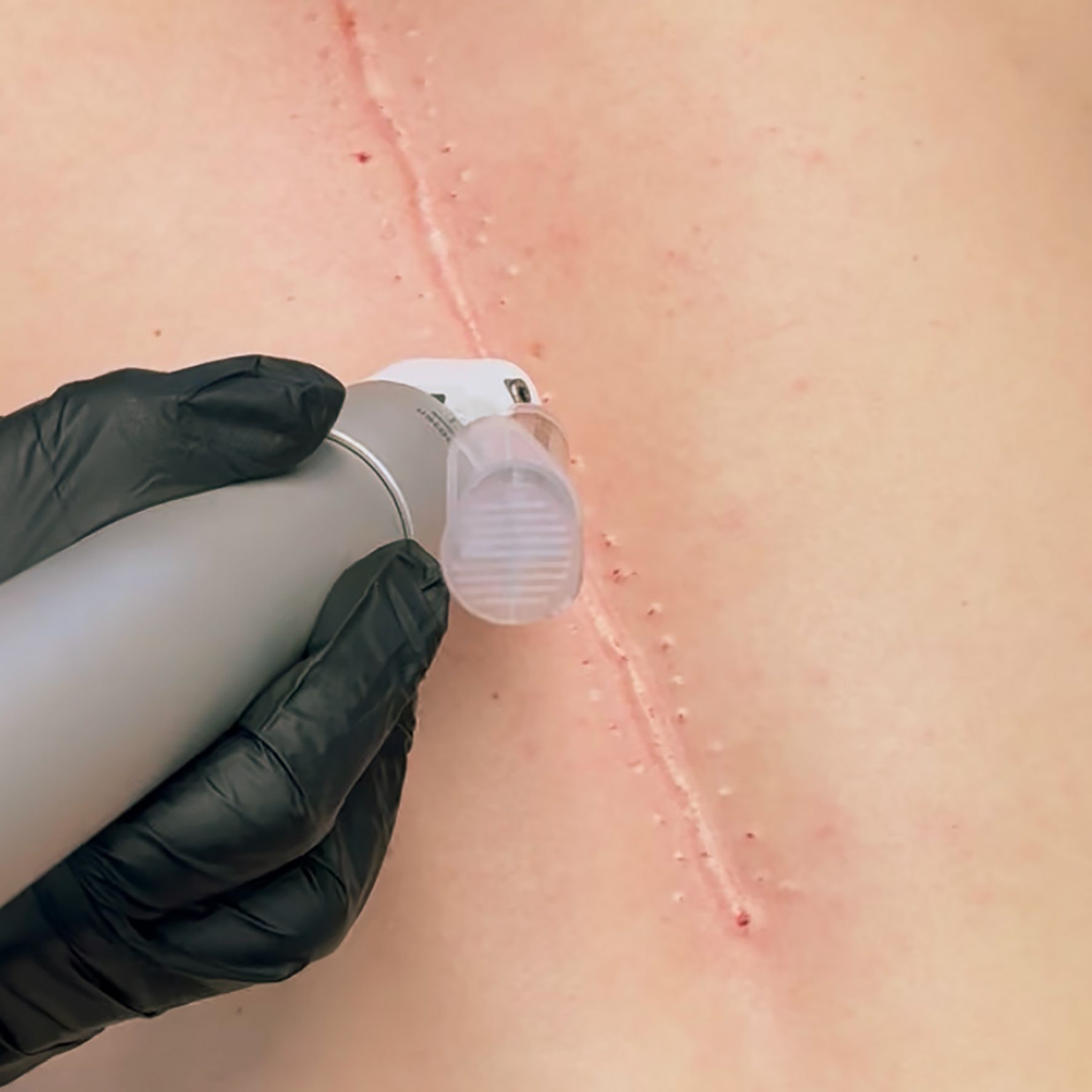 MSB Novojet arrbehandling IMG_7265 1x1 Nærbilde av hud med synlig arr som blir behandlet med Novojet hos Medskin Beauty