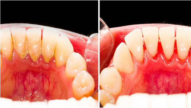 Voici comment éliminer la plaque dentaire naturellement à la maison dans des conditions naturelles