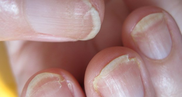 3 Remèdes pour empêcher vos ongles de se dédoubler