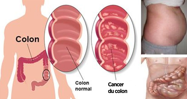 10 Signes précurseurs d’un cancer du côlon