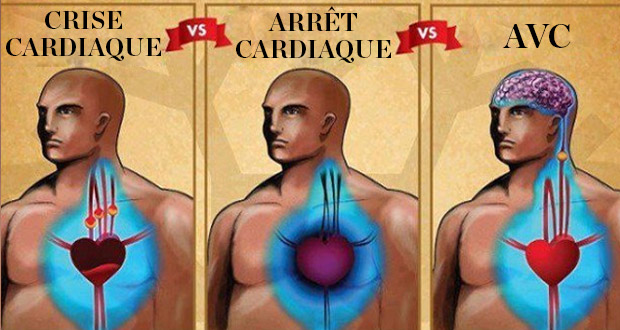 Quelle est la différence entre une crise cardiaque, un arrêt cardiaque et un AVC