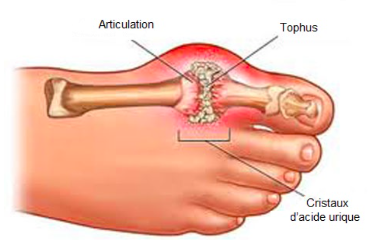 Un traitement naturel pour lutter contre la goutte