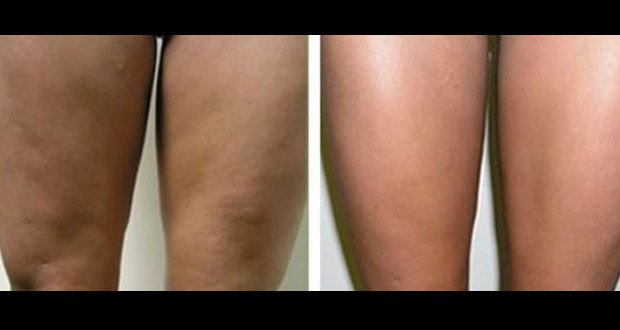 Débarrassez-vous de la cellulite avec ces traitements naturels !