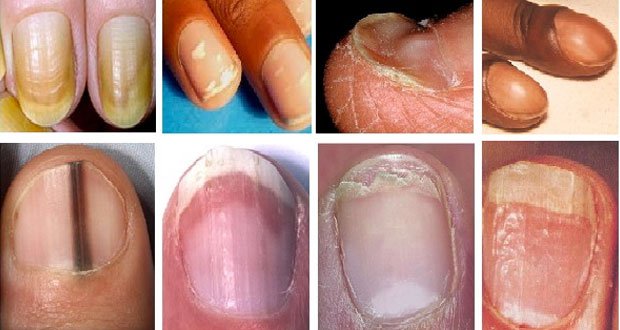 De graves problèmes de santé peuvent être signalés par vos ongles
