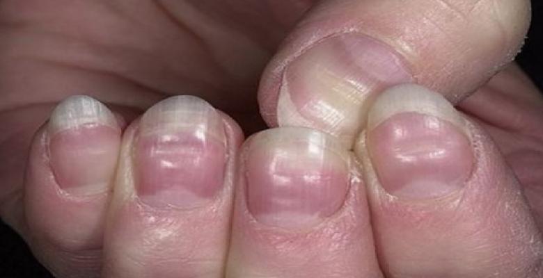 Vos ongles sont très révélateurs de votre état de santé : 15 signes à ne pas prendre à la légère